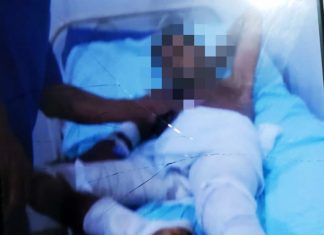 Mulher empurra marido dentro de buraco e ateia fogo; homem tem 70% do corpo queimado